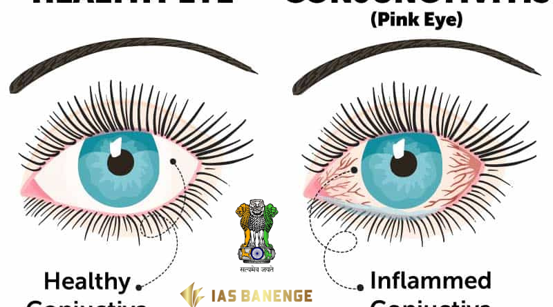 Conjunctivitis (Pink Eye)